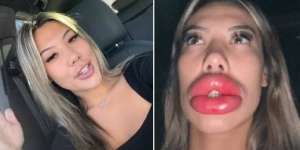 Ingin Bibir Lebih Seksi dengan Filler, Malah Berakhir Alergi Parah