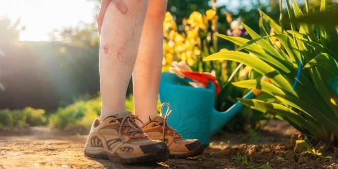 Perempuan Lebih Berisiko Terkena Varises, Ini Alasannya