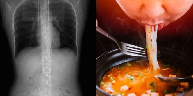 Batuk Usai Konsumsi Makanan Pedas, 4 Tulang Rusuk Wanita Ini Patah