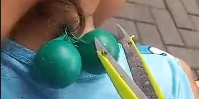 Bocah Main Lato-lato Sampai Nyangkut di Leher, Terpaksa Digunting