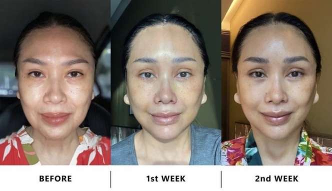 Transformasi Titi DJ dari Sebelum dan Sesudah Jalani Operasi Plastik, Wajah Sampai Tak Dikenali