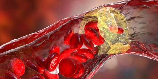 Cek Fakta: Menusuk Jari untuk Pertolongan Pertama Penderita Stroke