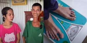 Pria Terkurus Sedunia Berbobot 20 Kg, Badan Tinggal Kulit dan Tulang, Punya Istri Setia dan Dibuatkan Rumah