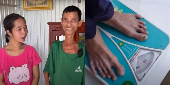 Pria Terkurus Sedunia Berbobot 20 Kg, Badan Tinggal Kulit dan Tulang, Punya Istri Setia dan Dibuatkan Rumah