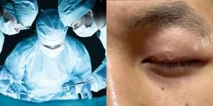 Selalu Perih Dikira Cuma Reaksi Saraf, Pria Syok Temukan Cacing Hidup di Kelopak Mata