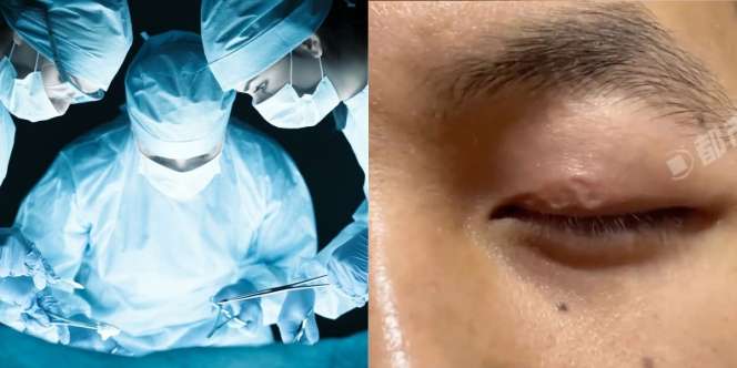 Selalu Perih Dikira Cuma Reaksi Saraf, Pria Syok Temukan Cacing Hidup di Kelopak Mata