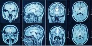 Kejadian Langka! Dokter Temukan Janin di Dalam Otak Bayi Berusia 1 Tahun