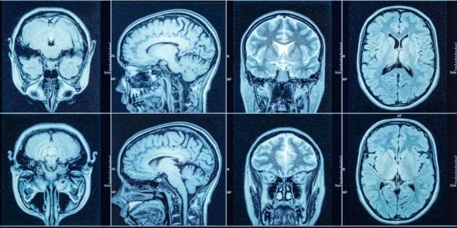 Kejadian Langka! Dokter Temukan Janin di Dalam Otak Bayi Berusia 1 Tahun