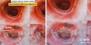 Ngeri! Pasien Ngeluh Sakit Perut Berulang, Ternyata Ususnya Bolong Gegara Sering Makan Pedas