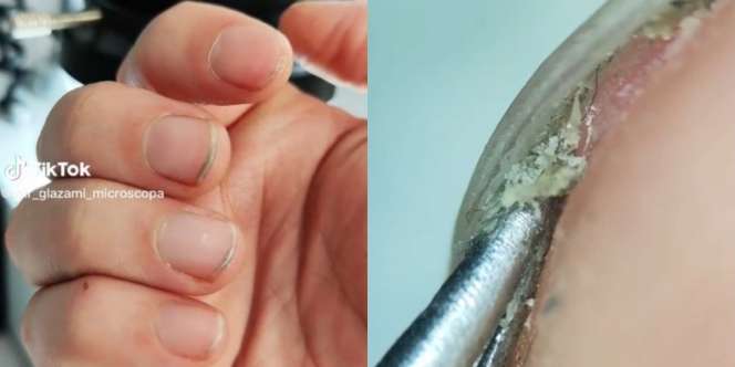 Kuku Hitam Dikeruk dan Dilihat di Bawah Mikroskop, Penampakannya Bikin Mual