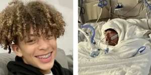 Demi Konten Tantangan di TikTok, Tubuh Remaja Ini Terbakar Sampai Tak Bisa Dikenali