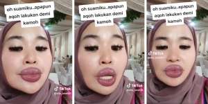 Ngakak! Wanita Ini Rela 'Operasi Plastik' Bikin Bibir Tebal Kayak Barbel Biar Suami Nggak Ngelirik Sana-sini
