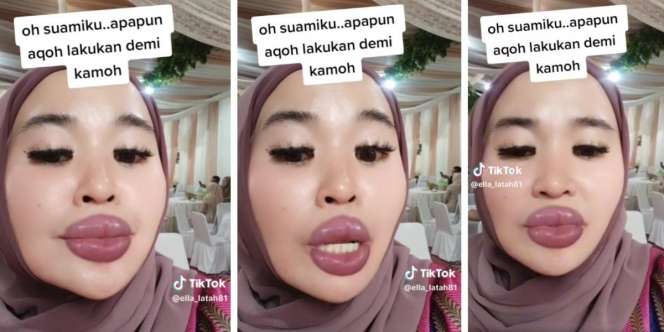 Ngakak! Wanita Ini Rela 'Operasi Plastik' Bikin Bibir Tebal Kayak Barbel Biar Suami Nggak Ngelirik Sana-sini