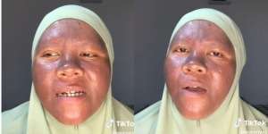 TikToker Curhat Wajah Gosong Akibat Salah Pakai Skincare, Jangan Asal Pakai Produk