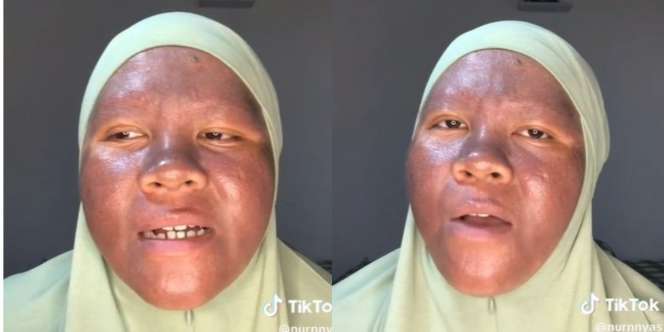 TikToker Curhat Wajah Gosong Akibat Salah Pakai Skincare, Jangan Asal Pakai Produk
