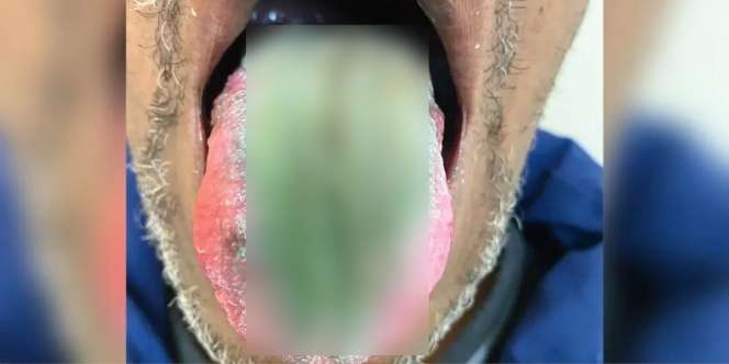 Kasus Langka, Lidah Pria Ini Jadi Hijau dan Berbulu, Diduga Akibat Merokok