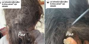 Bikin Merinding! Rambut Wanita Ini Dipenuhi Kutu hingga Kepala Bernanah