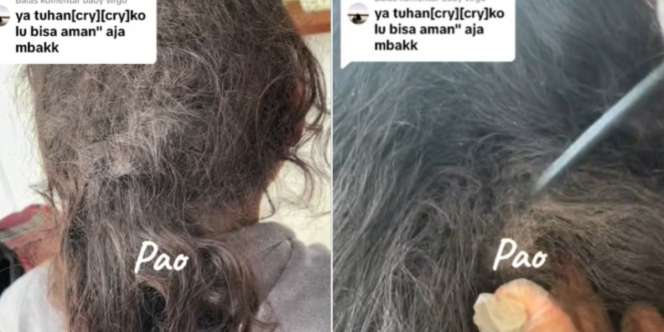 Bikin Merinding! Rambut Wanita Ini Dipenuhi Kutu hingga Kepala Bernanah