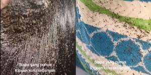 Kepala Gatal Dikira Ketombean, Saat Rambut Disibak Ribuan Kutu Rontok ke Lantai