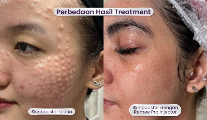 Leny Skincare Perkenalkan REMEE Pro Injector: Teknologi Canggih untuk Skinbooster Minim Rasa Sakit