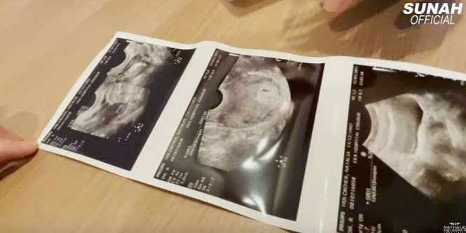 Tangis Nathalie Holscher Pecah Tahu Hamil Anak Sule