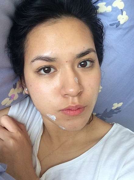 8 Seleb Cantik Tak Segan Pamer Wajah Berjerawat, Tuai Pujian!