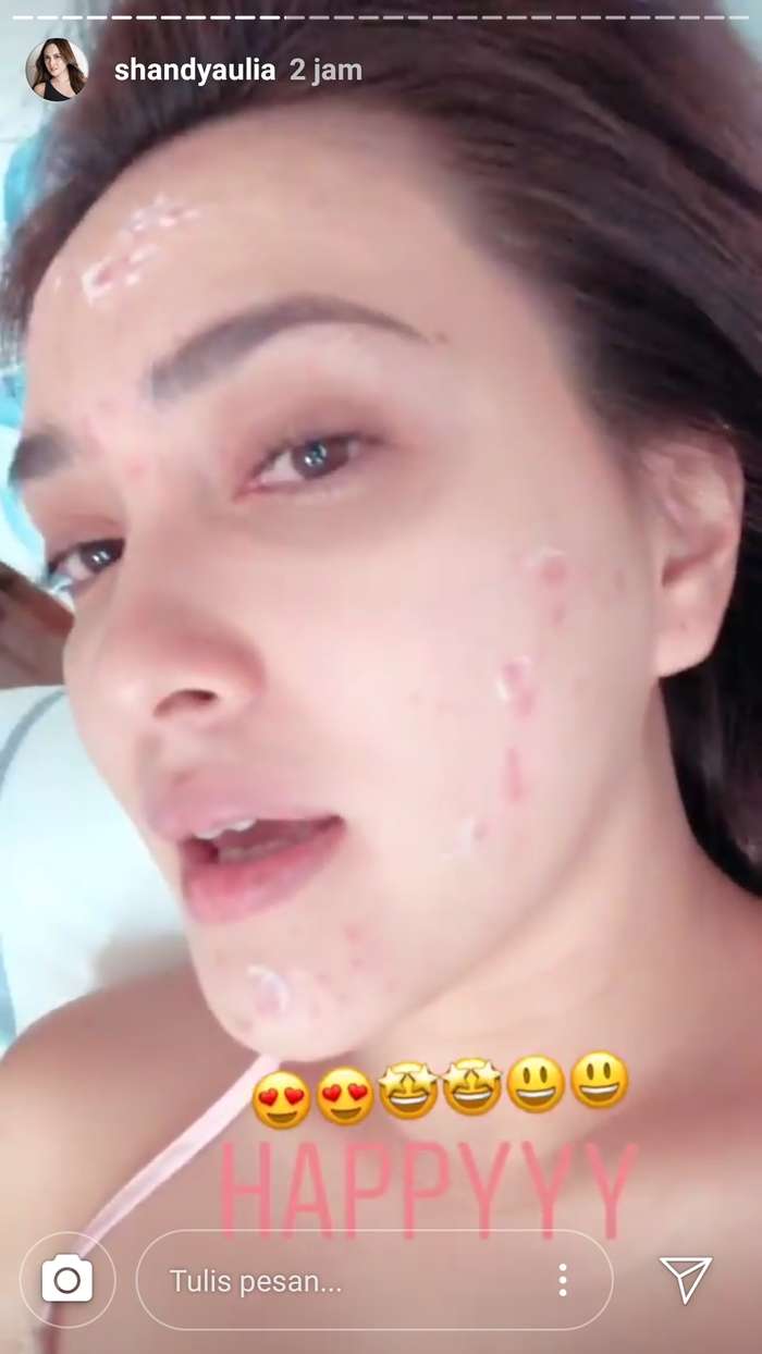 8 Seleb Cantik Tak Segan Pamer Wajah Berjerawat, Tuai Pujian!