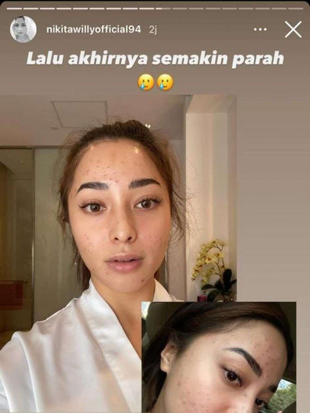 8 Seleb Cantik Tak Segan Pamer Wajah Berjerawat, Tuai Pujian!