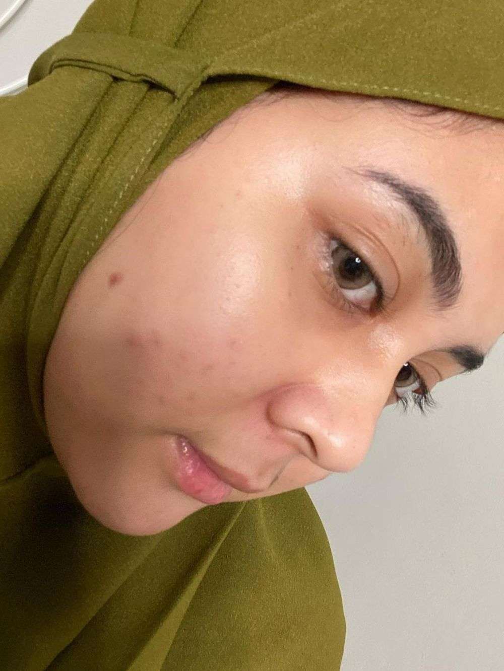 8 Seleb Cantik Tak Segan Pamer Wajah Berjerawat, Tuai Pujian!