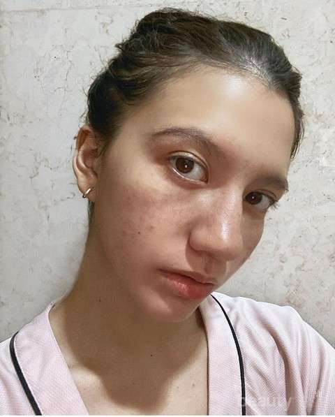 8 Seleb Cantik Tak Segan Pamer Wajah Berjerawat, Tuai Pujian!
