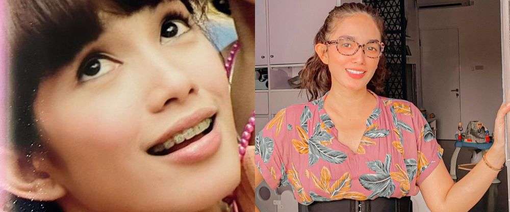 7 Seleb Ini Ternyata Pernah Pakai Behel, Luna Maya Manglingi!