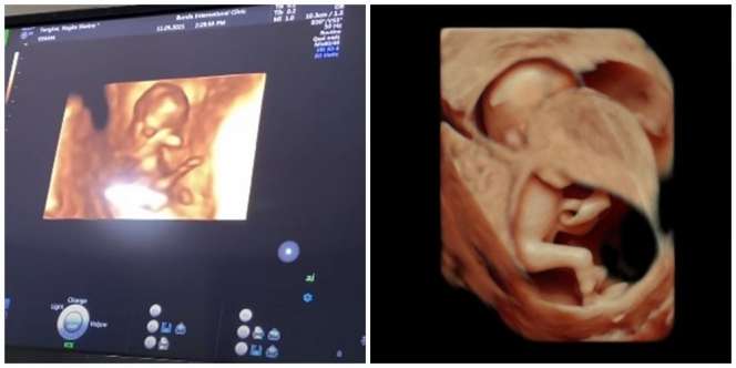 Momen Bahagia Nagita Slavina Cek Kandungan Ditemani Rafathar