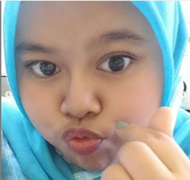 Potret Kekeyi Setelah Filler Hidung, Foto Before-After Viral