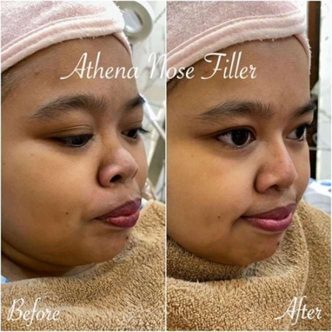 Potret Kekeyi Setelah Filler Hidung, Foto Before-After Viral