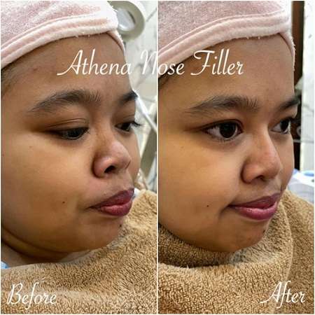 Potret Kekeyi Setelah Filler Hidung, Foto Before-After Viral
