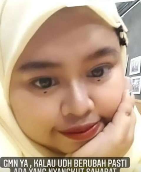 Potret Kekeyi Setelah Filler Hidung, Foto Before-After Viral