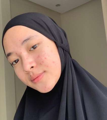 7 Potret Nissa Sabyan Tampil Polos, Jerawatan