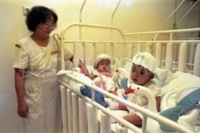 Kabar Bayi Kembar Siam Yuliana-Yuliani, Kini Jadi Orang Hebat