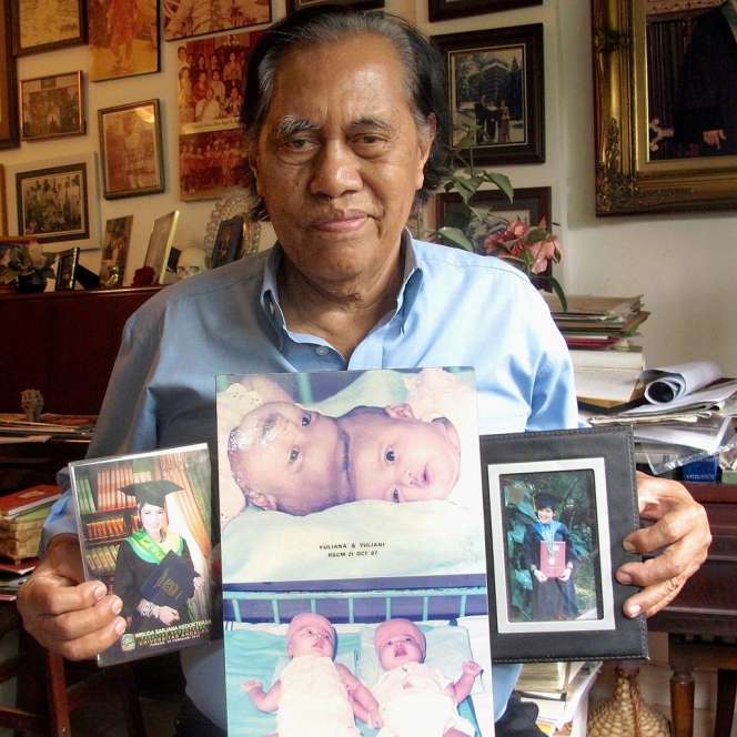 Kabar Bayi Kembar Siam Yuliana-Yuliani, Kini Jadi Orang Hebat
