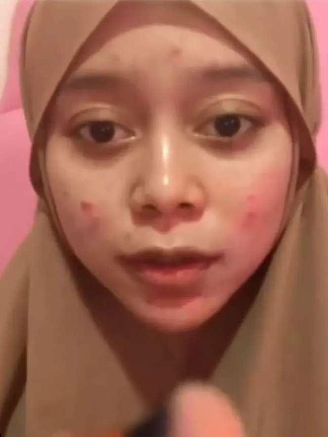 7 Seleb Cantik Pejuang Jerawat, Ada yang Sampai Parah Banget!