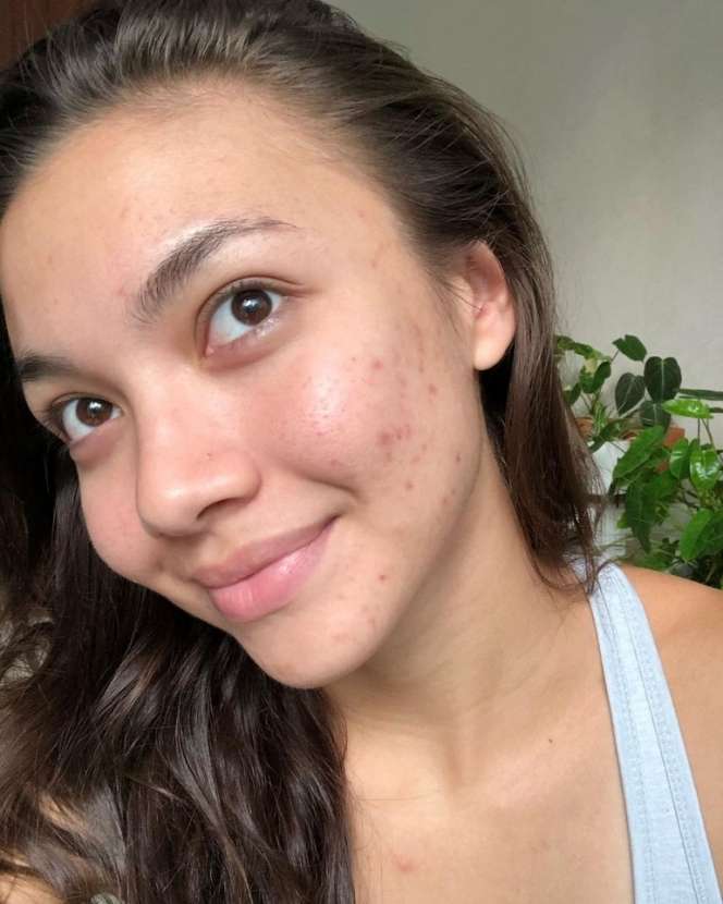 7 Seleb Cantik Pejuang Jerawat, Ada yang Sampai Parah Banget!