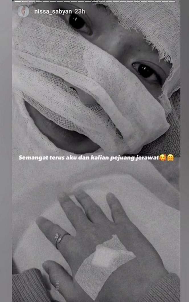 7 Seleb Cantik Pejuang Jerawat, Ada yang Sampai Parah Banget!