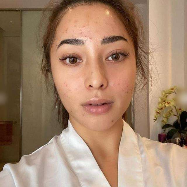7 Seleb Cantik Pejuang Jerawat, Ada yang Sampai Parah Banget!