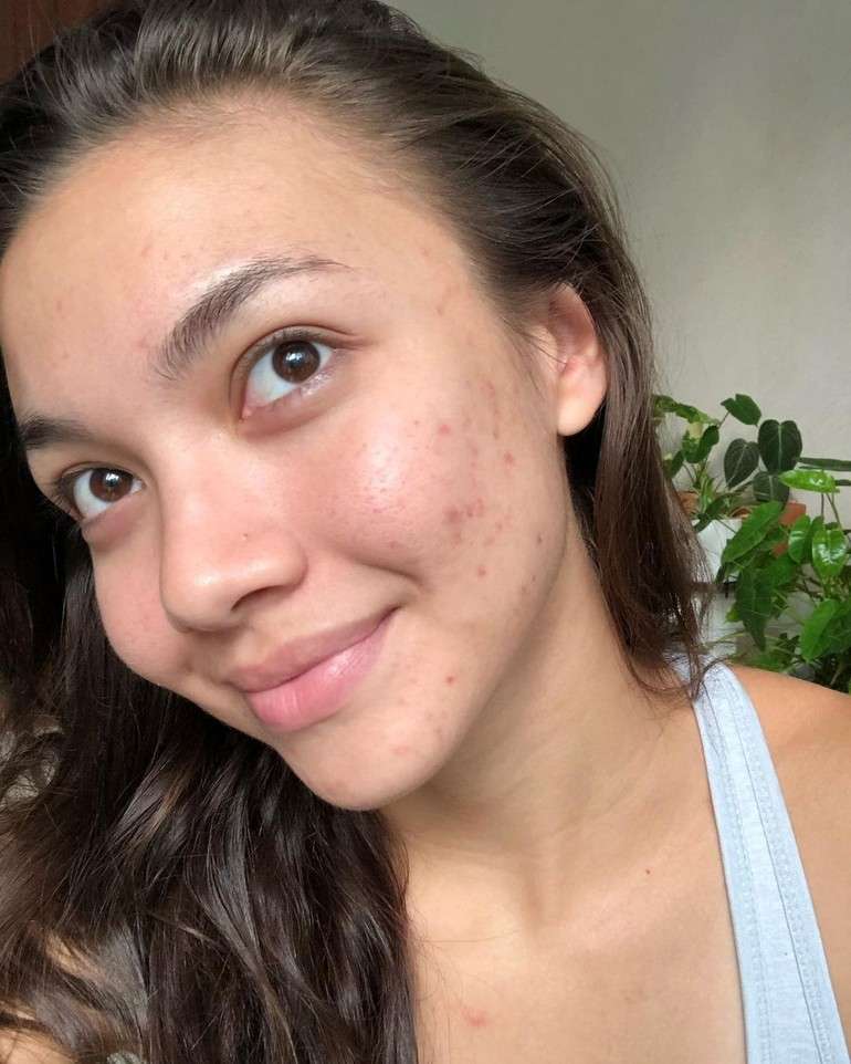 7 Seleb Cantik Pejuang Jerawat, Ada yang Sampai Parah Banget!