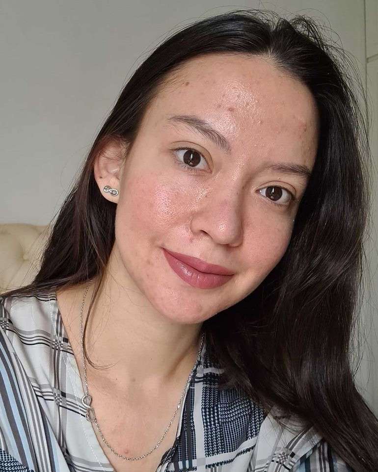 7 Seleb Cantik Pejuang Jerawat, Ada yang Sampai Parah Banget!