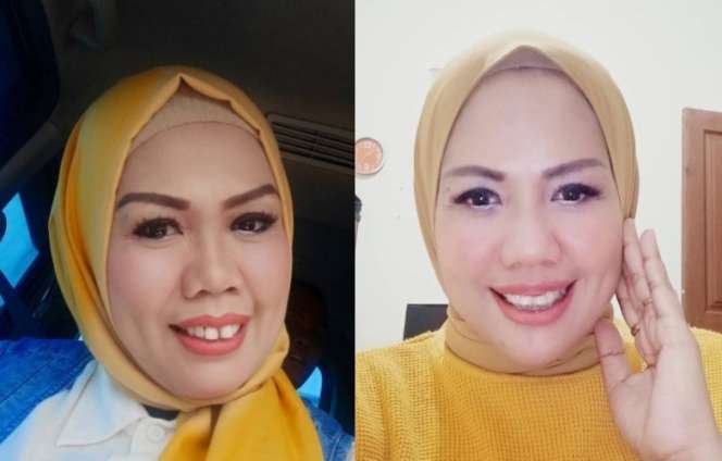 Potret Elly Sugigi Sebelum-Sesudah Perawatan, Melongo Lihatnya