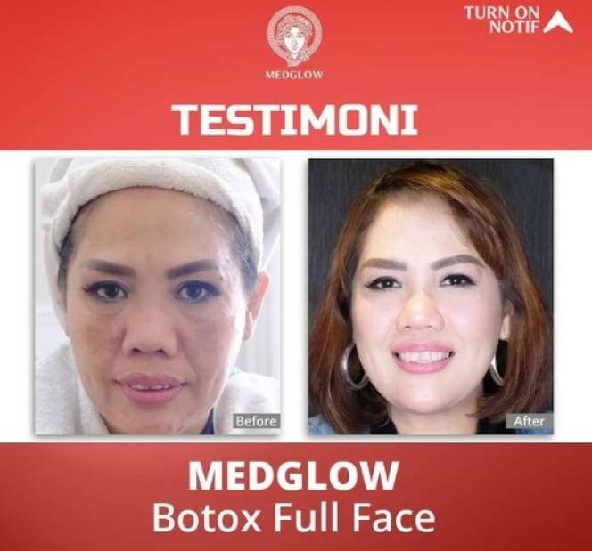 Potret Elly Sugigi Sebelum-Sesudah Perawatan, Melongo Lihatnya