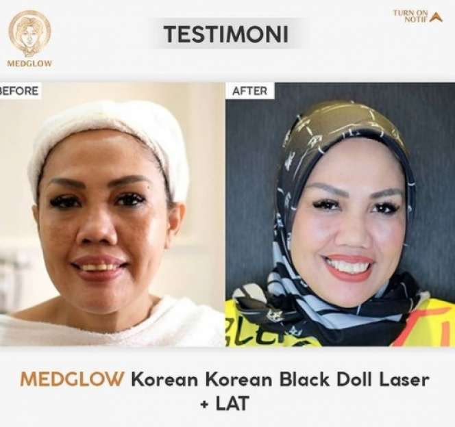 Potret Elly Sugigi Sebelum-Sesudah Perawatan, Melongo Lihatnya
