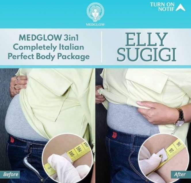 Potret Elly Sugigi Sebelum-Sesudah Perawatan, Melongo Lihatnya