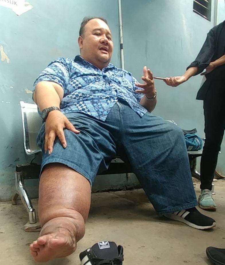 6 Potret Kondisi Terakhir Rony Dozer Sebelum Meninggal Dunia, Pernah Ngaku Kena Santet!